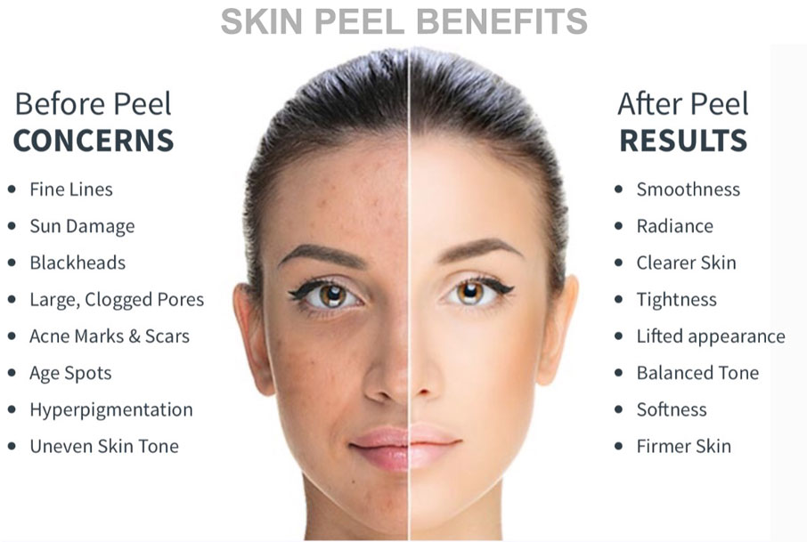 Chemical-Peel-Results