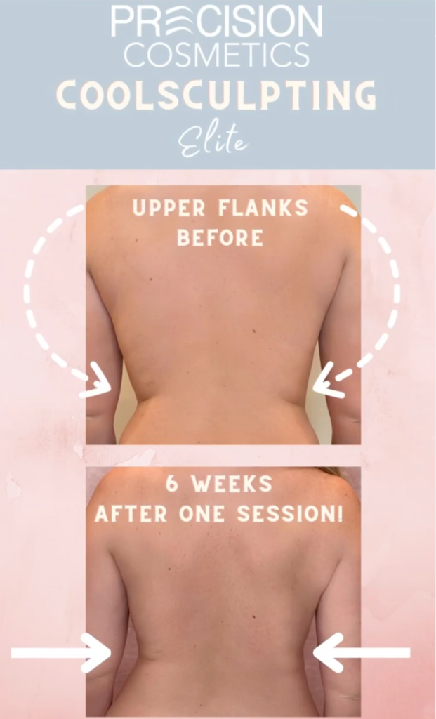 Coolsculpting Results Flanks